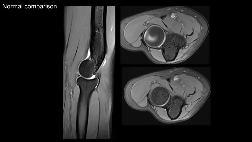 Figure 5 for case Volar dislocation of the radial head